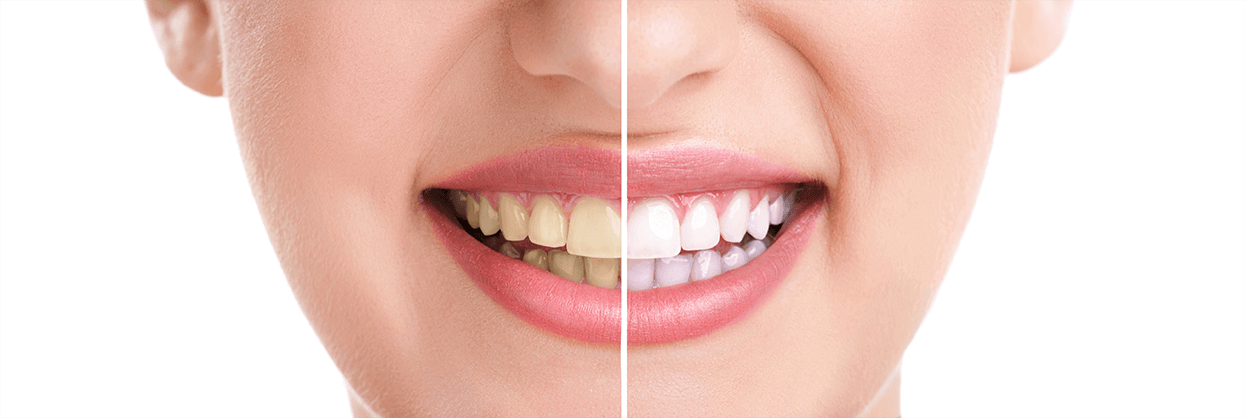 Teeth Whitening in Danbury, CT